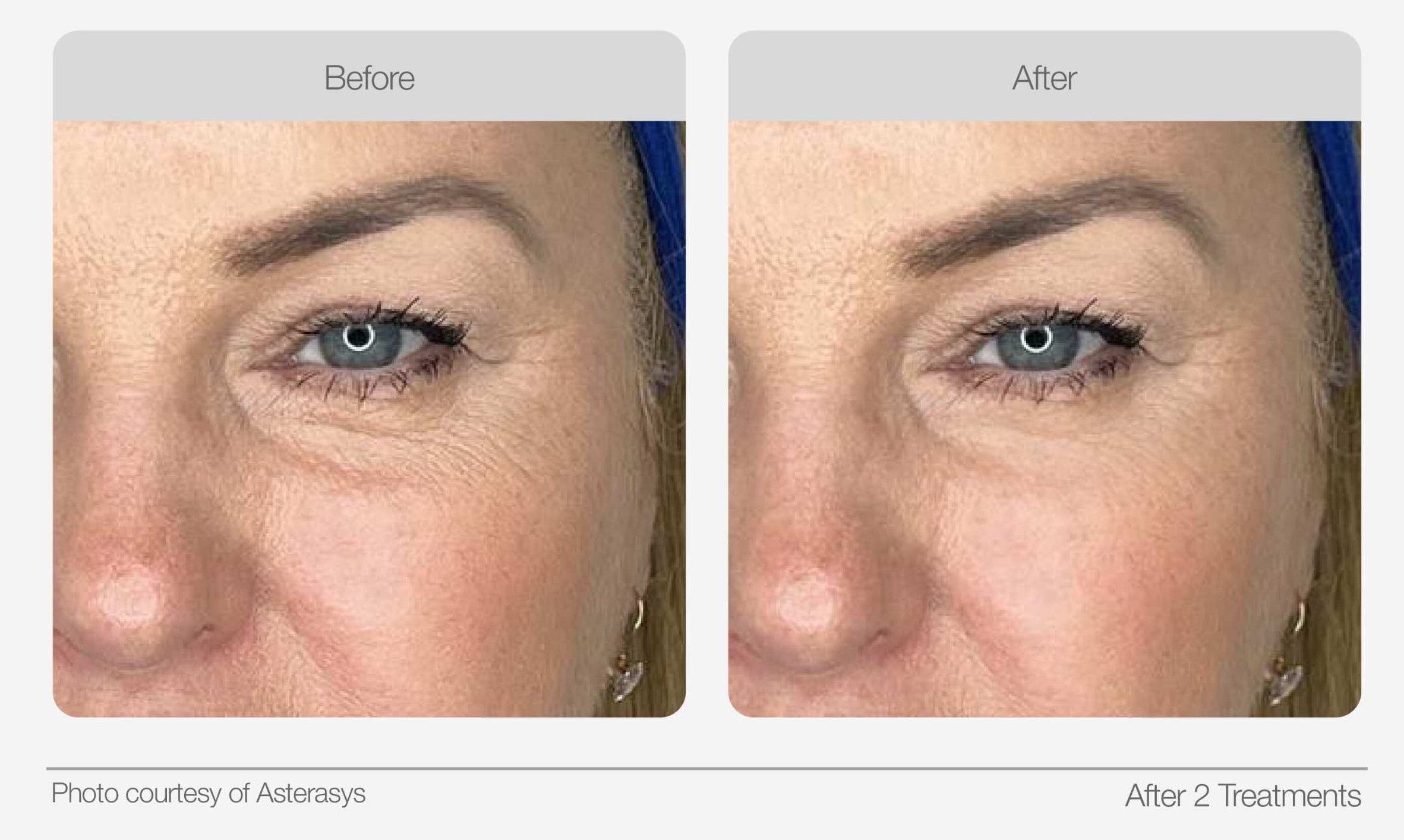 Eye area before and after comparison