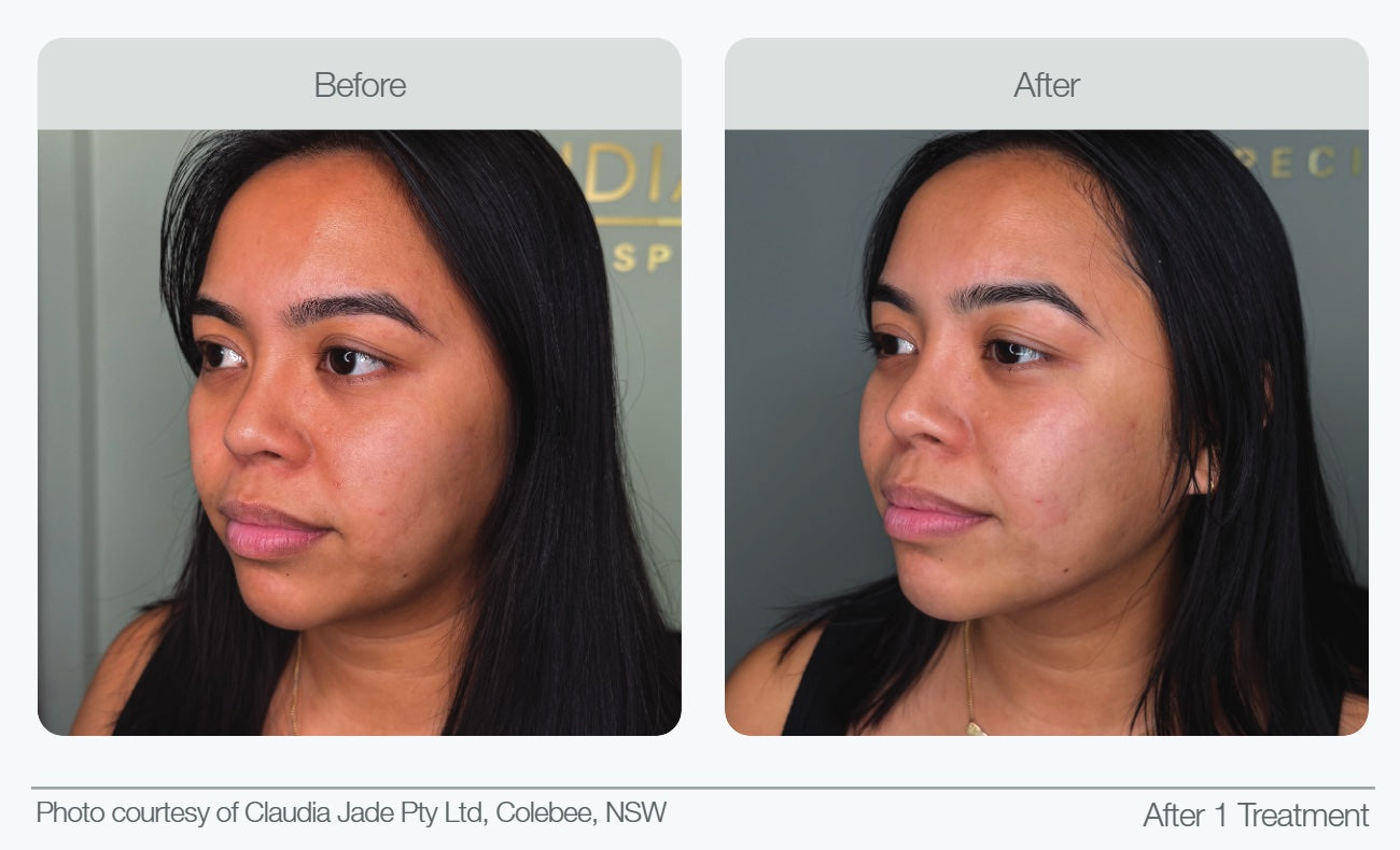 Face profile before and after comparison