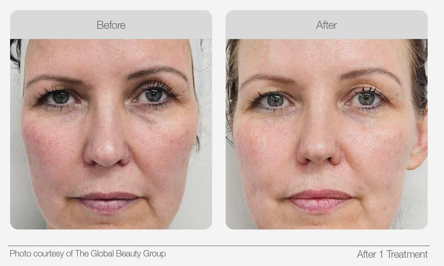 Full face before and after comparison