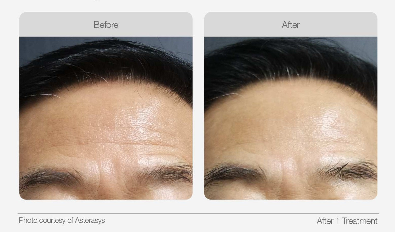 Forehead before and after comparison