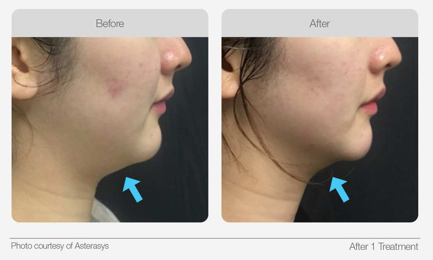 Jawline before and after comparison