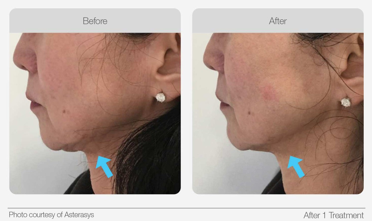 Lower face and neck before and after comparison