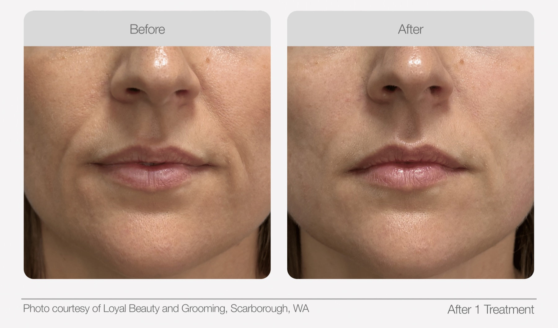Lower face before and after comparison